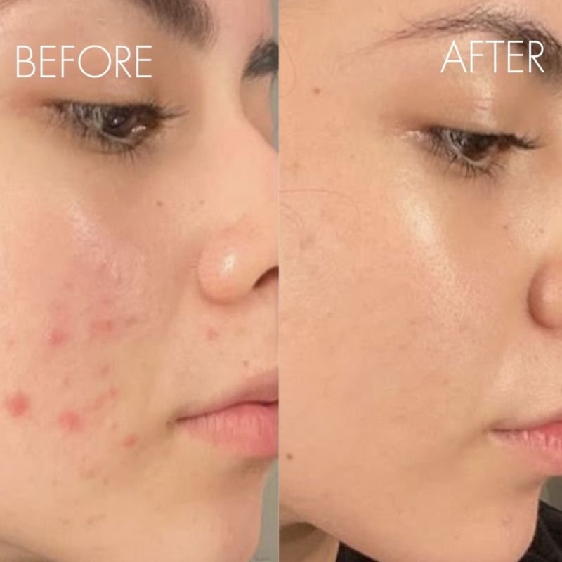Before and after acne treatment: inflamed breakouts on the cheek