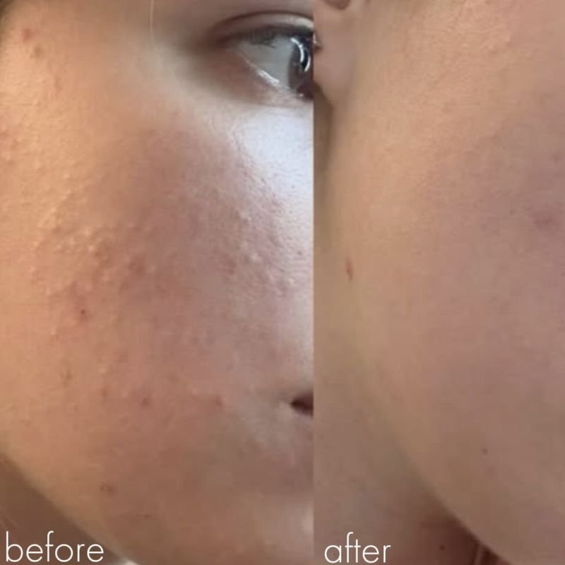 Before and after acne treatment: uneven, bumpy texture