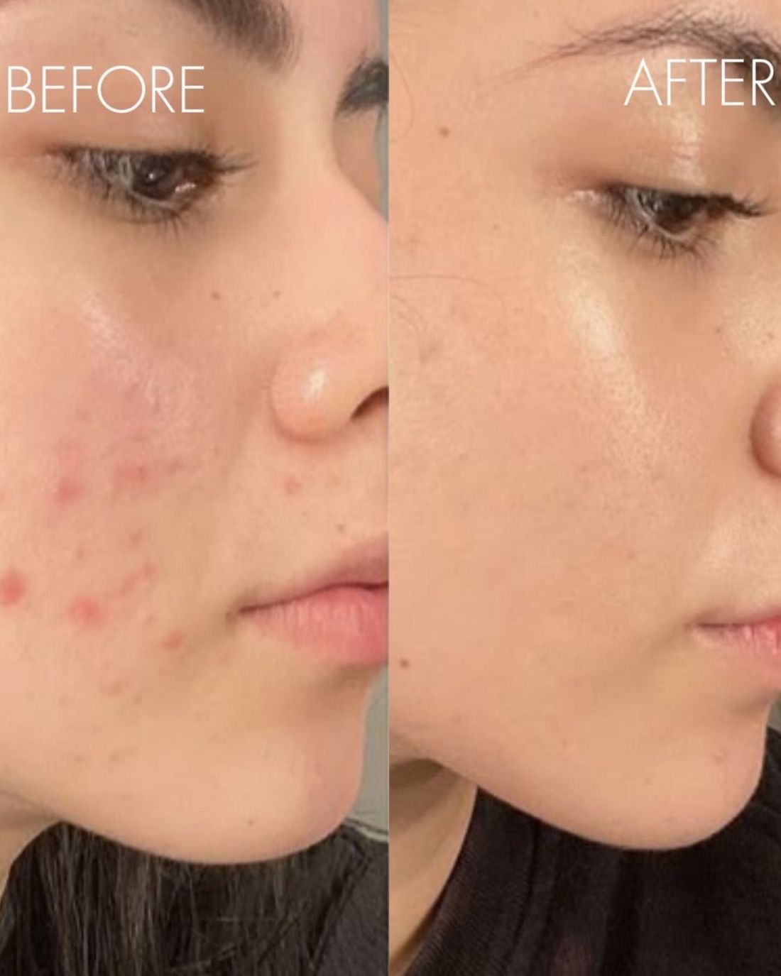 Before and after acne treatment
